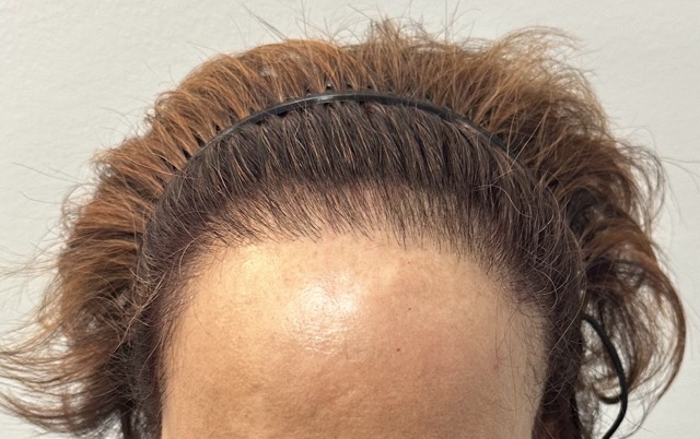 gemaakte haarlijn na geslaagde haartransplantatie bij frontale fibrosing alopecia bij vrouwen