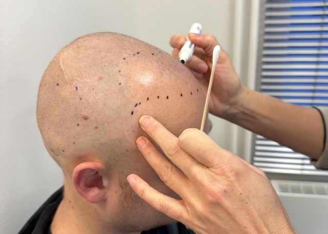 haarlijn tekenen hair and skin institute haartransplantatie Maastricht beste team met kristel van herwijnen