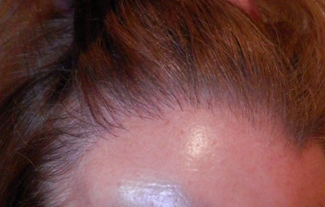 natuurlijke haarlijn bij een vrouw door kristel van herwijnen bij haartransplantatie Maastricht