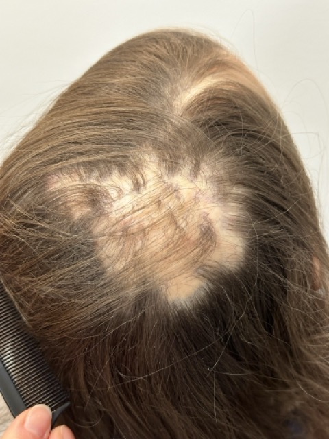 haartransplantatie litteken door kristel van herwijnen bij hair and skin institute in Maastricht