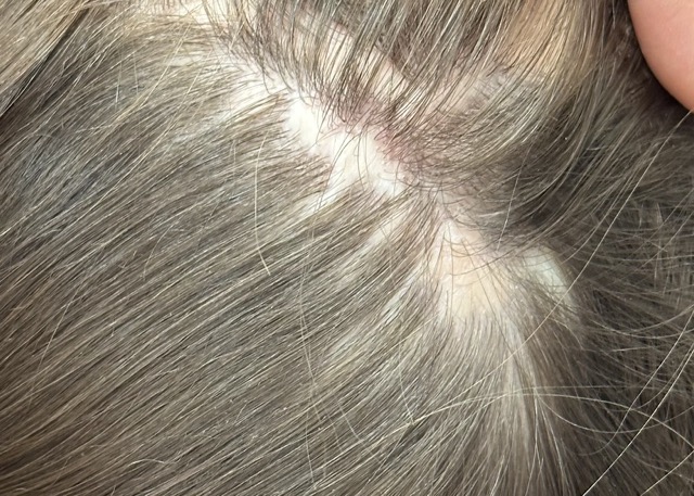 litteken klein bij hair and skin institute door Kristel van Herwijnen beste haartransplantatie Maastricht