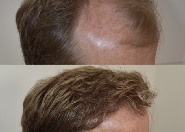 natuurlijke haarlijn maken door kristel van herwijnen bij hair and Skin Institute beste haartransplantatie Maastricht en Amsterdam