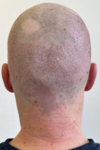 beste haartransplantatie natuurlijk resultaat bij hair and Skin Institute door Kristel van Herwijnen in Maastricht