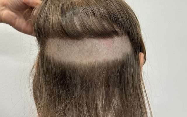 haarsparende behandeling zonder scheren bij vrouw, mooi bedekt donorgebied door Kristel van Herwijnen, ervaren team