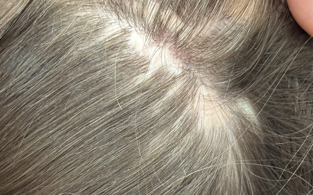 litteken klein bij hair and skin institute door Kristel van Herwijnen beste haartransplantatie Maastricht