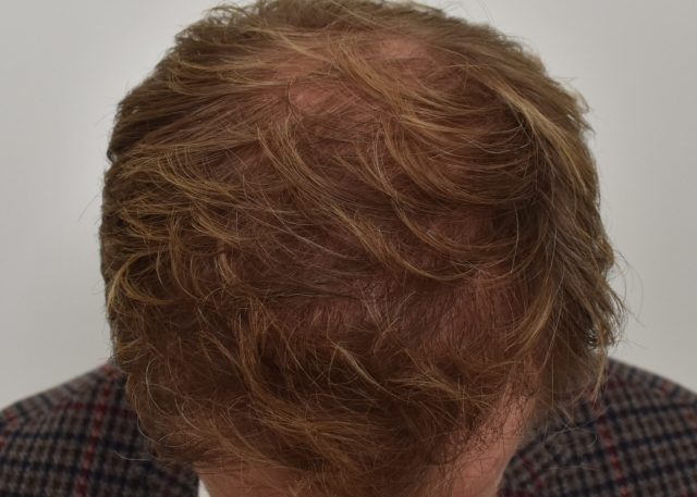 man voorzijde mooie natuurlijke haarlijn door hair and skin institute kristel van herwijnen
