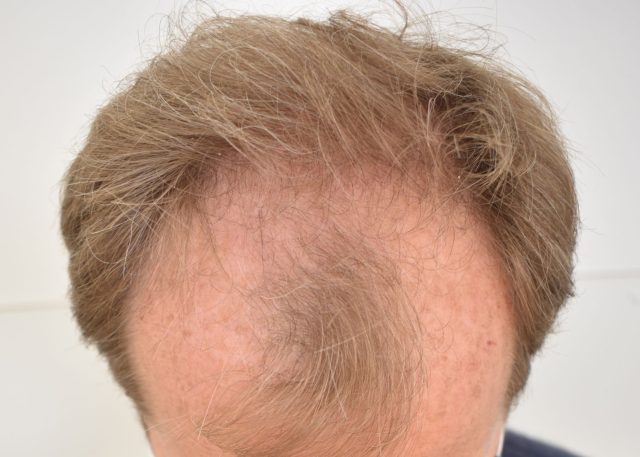 haaruitval man alopecia androgenetica kaalheid inhammen dunner wordend haar zelfvertrouwen pruik haarstuk toupet haarsparende indrukwekkende resultaten
